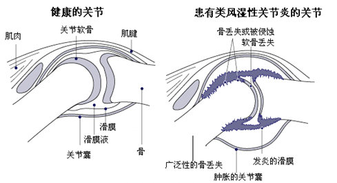 Fꖏ(qing)ֱt(y)ԺL(fng)񲡰l(f)ʾD.jpg
