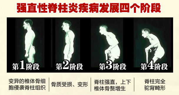 強(qiáng)直性脊柱炎病情發(fā)展配圖.jpg