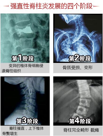 強(qiáng)直性脊柱炎發(fā)展的四個(gè)階段.jpg