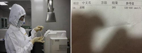 貴陽強直醫(yī)院尿酸檢查.jpg