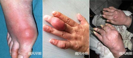 貴陽強直醫(yī)院痛風誘發(fā)后不同時期的癥狀.jpg