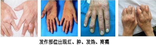 貴陽強直醫(yī)院手部痛風(fēng)癥狀.jpg