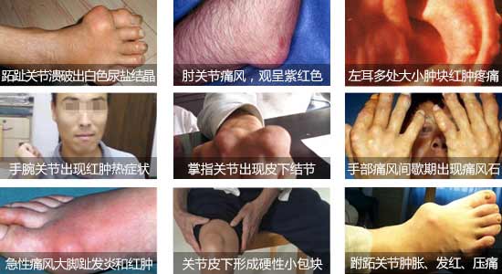 貴陽強(qiáng)直醫(yī)院痛風(fēng)發(fā)病的癥狀.jpg