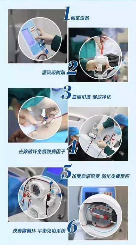免疫吸附療法步驟解析圖.jpg